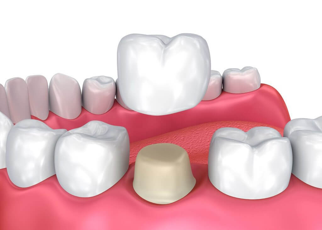 Dental crown being placed over a prepared tooth