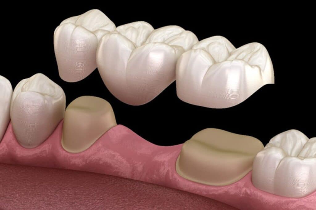 Three-unit dental bridge illustration