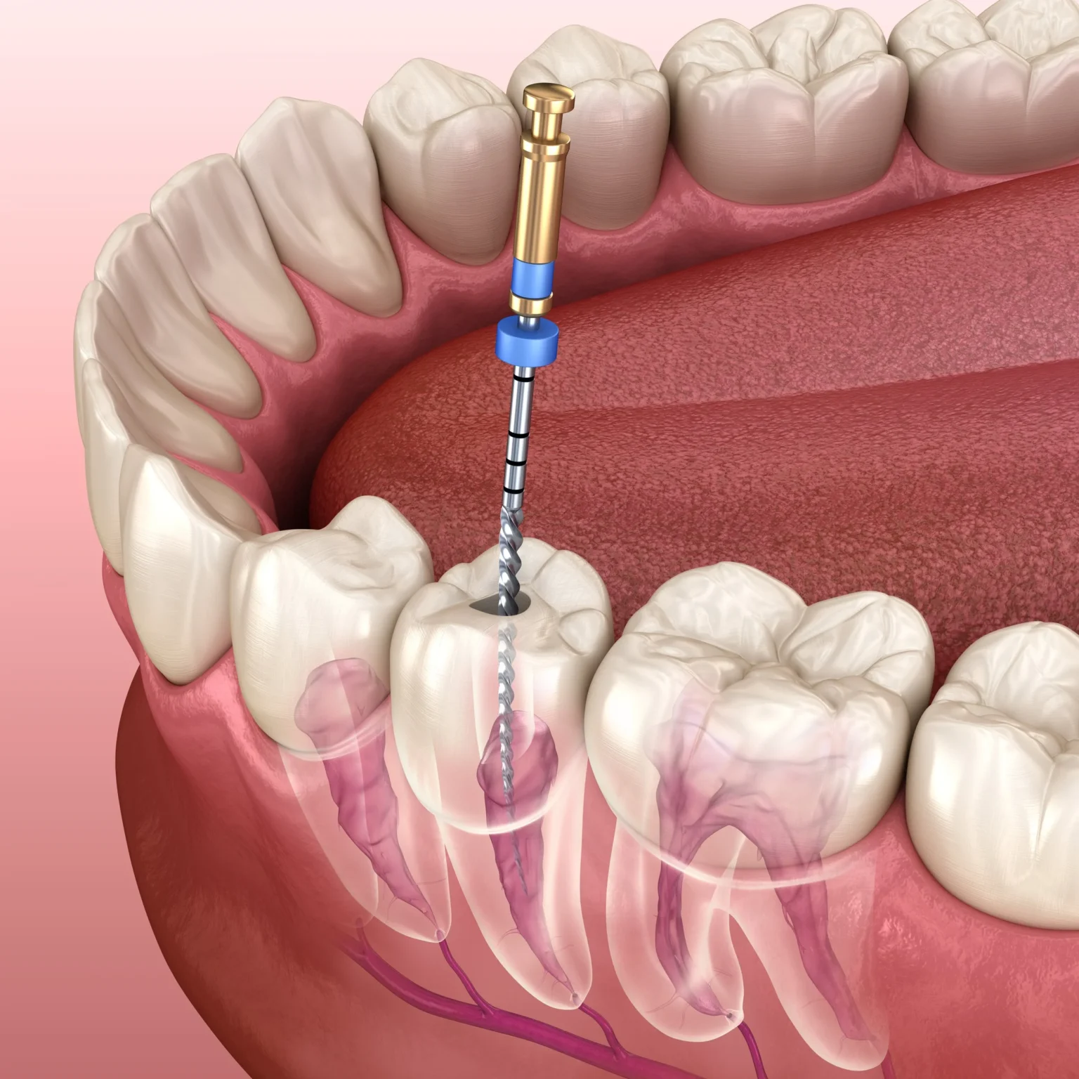 Illustration of a root canal treatment on a molar