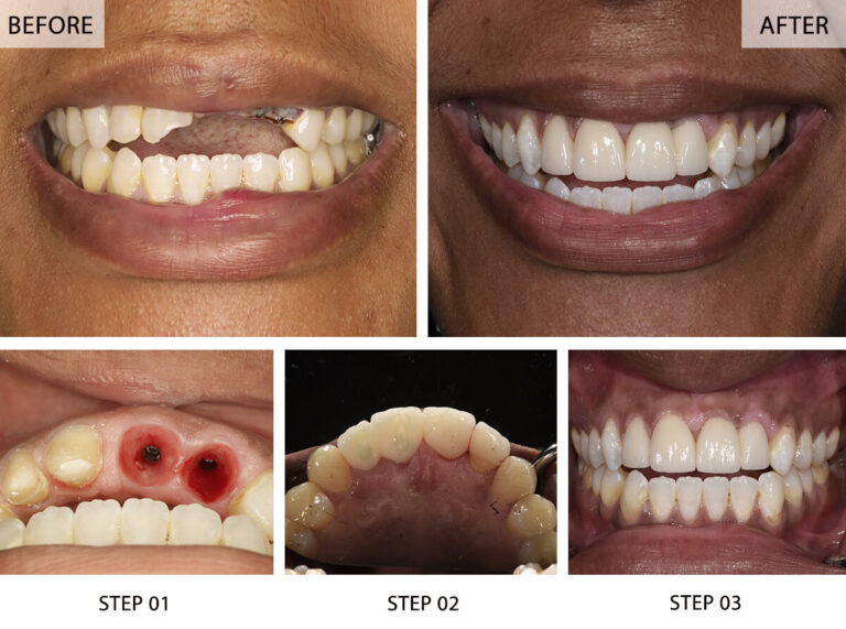 Before and after of a single tooth dental implant
